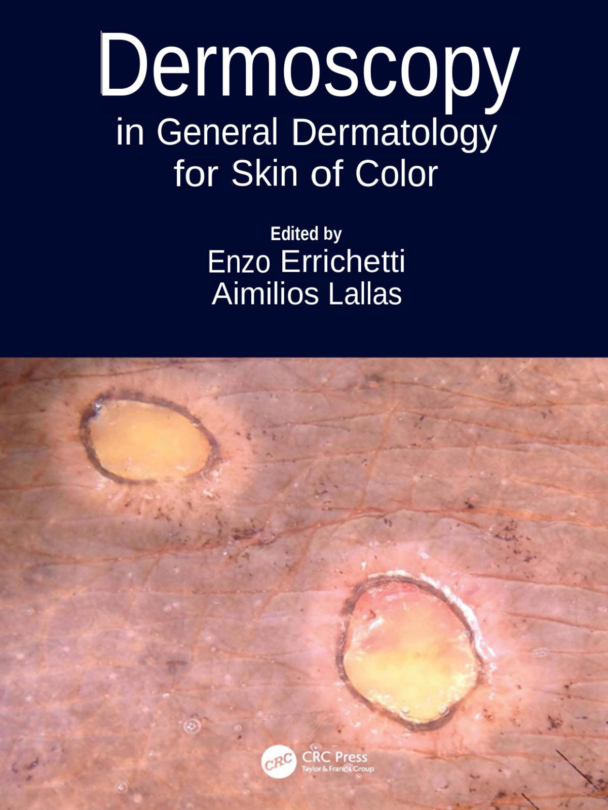 Dermoscopy In General Dermatology For Skin Of Color 1st Edition Enzo Errichetti
