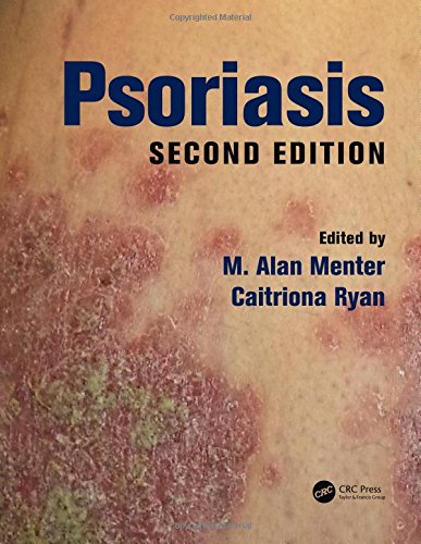 Psoriasis 2nd Ed 2nd Edition M Alan Menter Caitriona Ryan