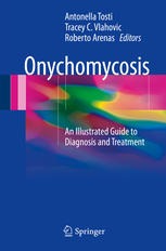 Onychomycosis An Illustrated Guide To Diagnosis And Treatment 1st Edition Antonella Tosti