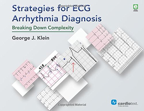 Strategies For Ecg Arrhythmia Diagnosis Breaking Down Complexity 1st Edition George J Klein
