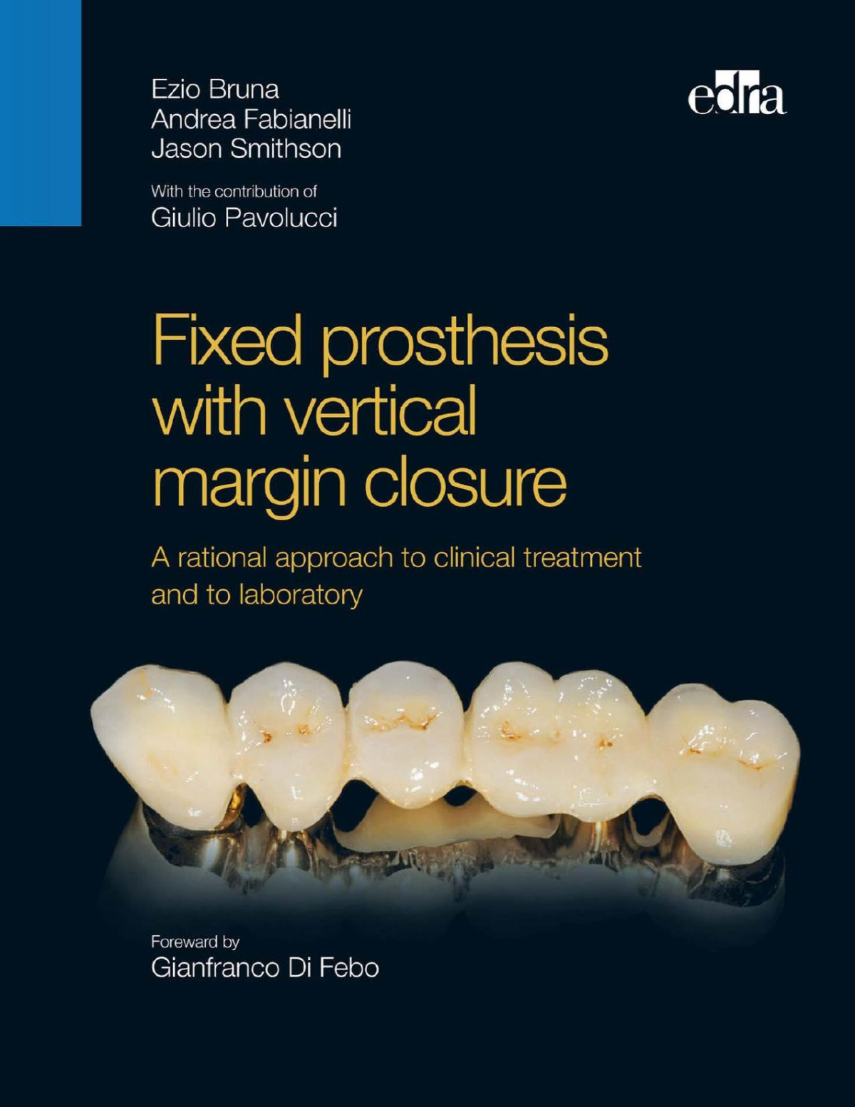 Fixed Prosthesis With Vertical Margin Closure A Rational Approach To Clinical Treatment And Laboratory Procedures Ezio Bruna Andrea Fabianelli