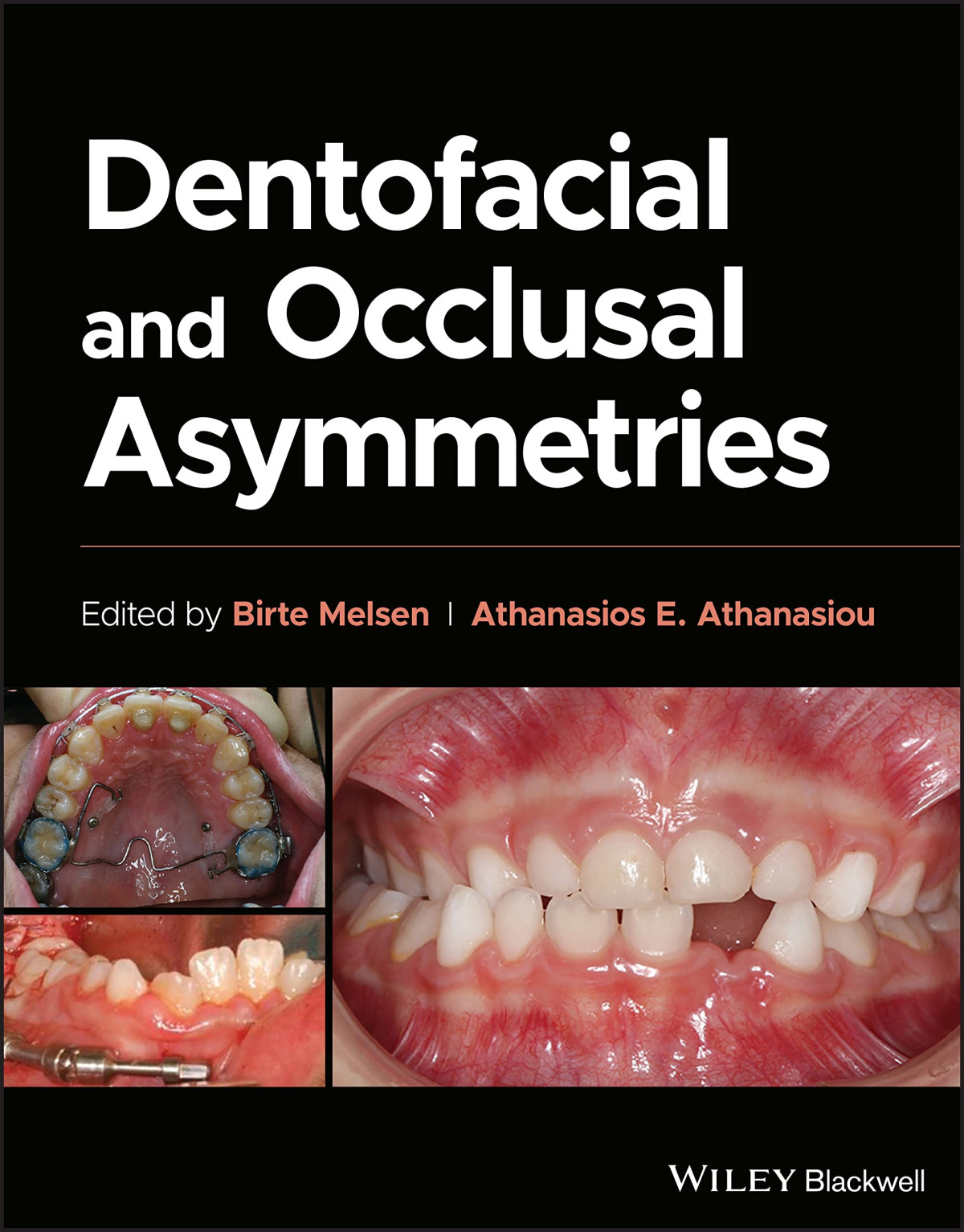 Dentofacial And Occlusal Asymmetries 1st Edition Birte Melsen