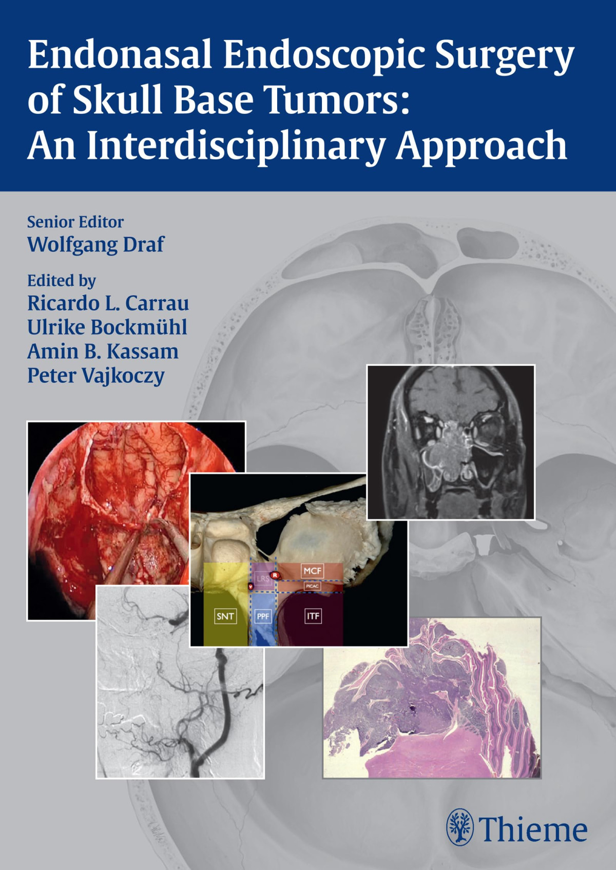 Endonasal Endoscopic Surgery Of Skull Base Tumors An Interdisciplinary Approach 1st Edition Wolfgang Draf