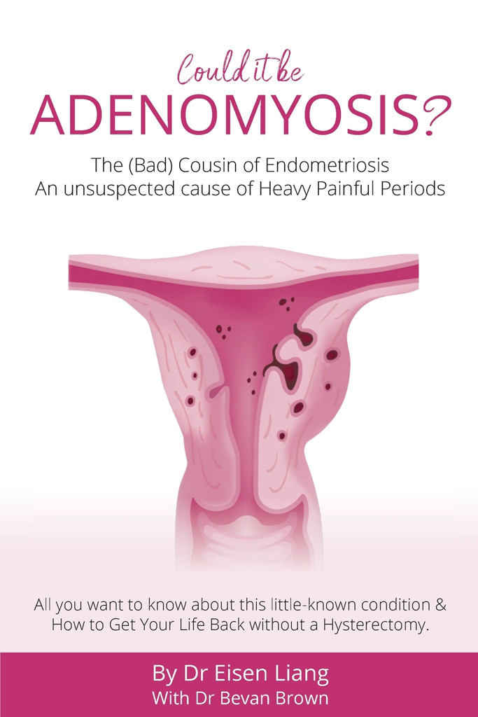 Adenomyosis The Bad Cousin Of Endometriosis Eisen Liang Dr Bevan Brown