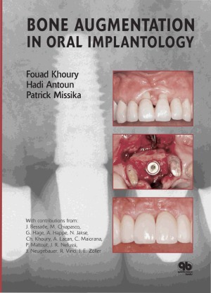 Bone Augmentation In Oral Implantology Fouad Khoury