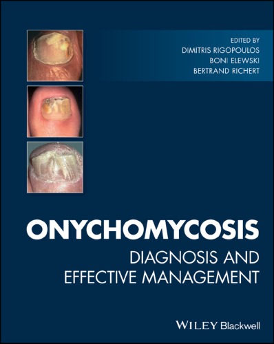 Onychomycosis Diagnosis And Effective Management Elewski Boni E Richert