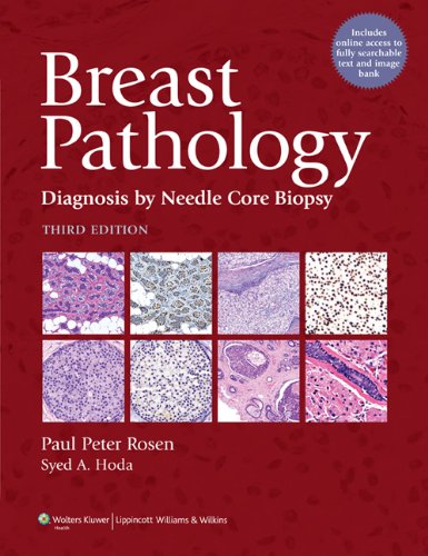 Breast Pathology Diagnosis By Needle Core Biopsy Third Paul Peter Rosen Md