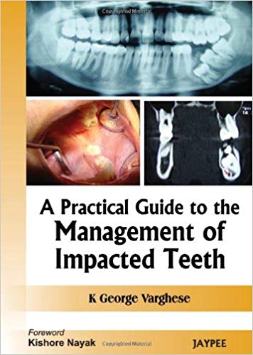 A Practical Guide To The Management Of Impacted Teeth 1st Edition K George Varghese