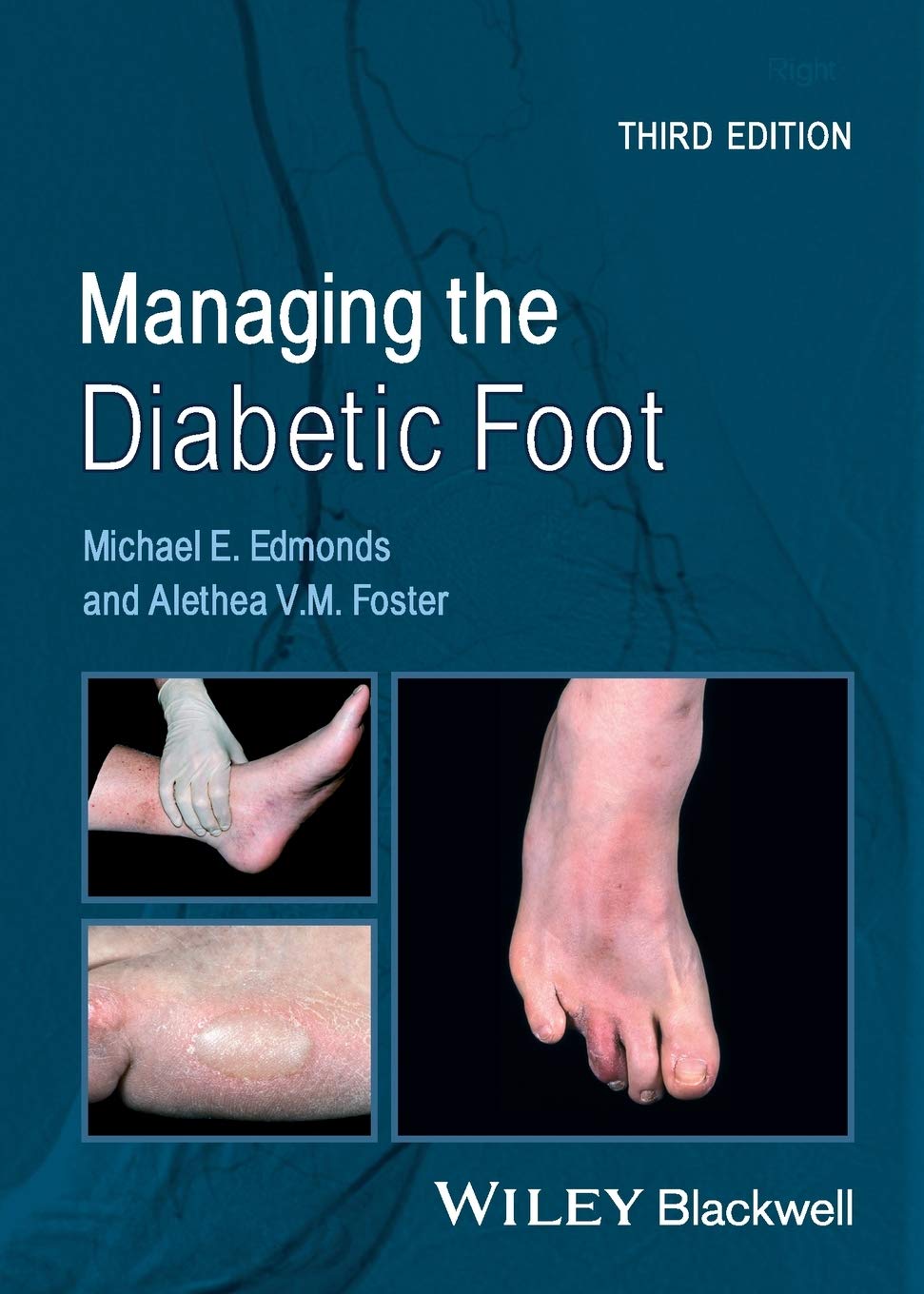 Managing The Diabetic Foot 3rd Edition Michael Eedmonds Alethea Vmfoster