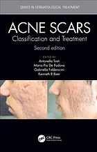 Acne Scars Classification And Treatment 2nd Edition Antonell Tosti