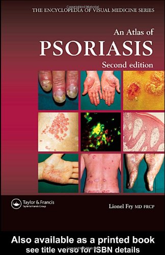 An Atlas Of Psoriasis Second Edition 2nd Edition Lionel Fry