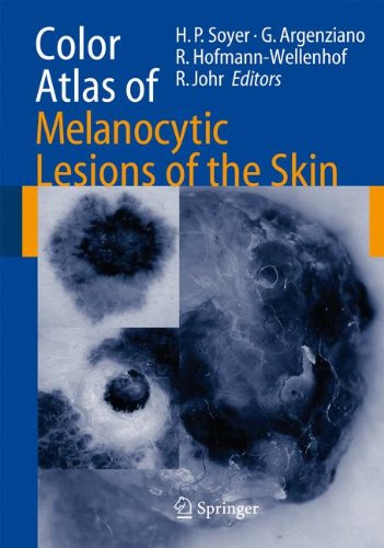 Color Atlas Of Melanocytic Lesions Of The Skin 1st Edition Hans Peter Soyer
