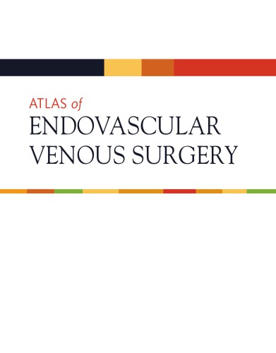 Atlas Of Endovascular Venous Surgery 2nd Ed Almeida Jose