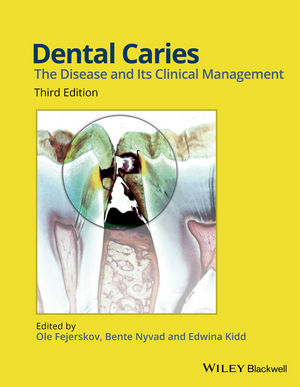 Dental Caries The Disease And Its Clinical Management 3rd Ole Fejerskov