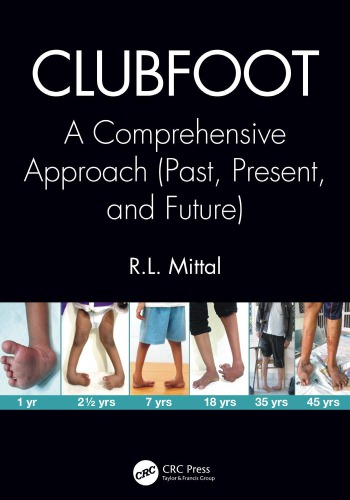 Clubfoot A Comprehensive Approach Past Present And Future Mittal