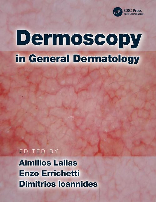 Dermoscopy In General Dermatology Aimilios Lallas Enzo Errichetti
