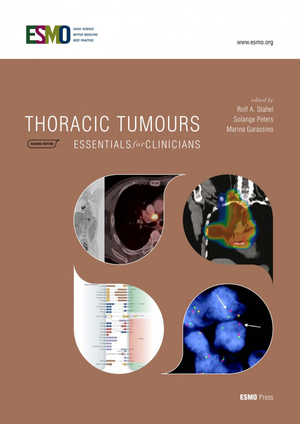 Thoracic Tumours Essentials For Clinician 2nd Edition Second Edition Rolf A Stahel