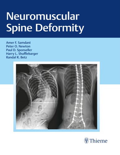 Neuromuscular Spine Deformity Betz Randal R Newton Peter O Samdani