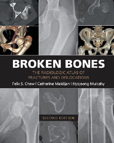 Broken Bones The Radiologic Atlas Of Fractures And Dislocations 2nd Edition Felix S Chew
