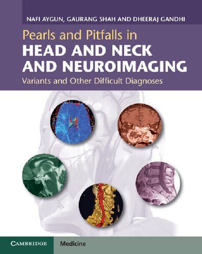 Pearls And Pitfalls In Head And Neck And Neuroimaging Variants And Other Difficult Diagnoses New Nafi Aygun