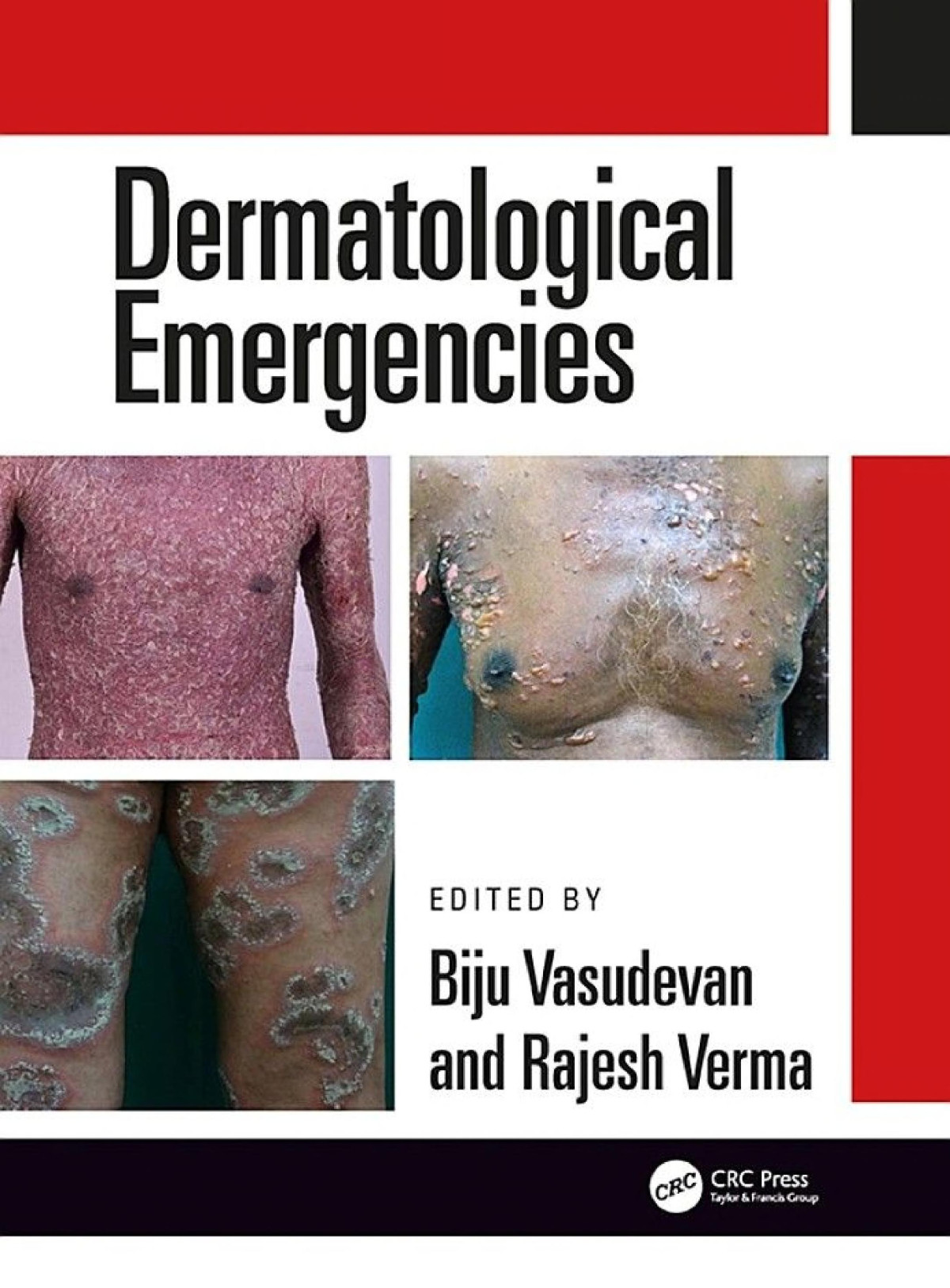 Dermatological Emergencies Rajesh Verma Biju Vasudevan