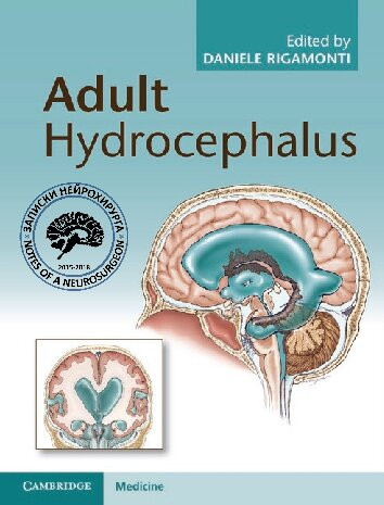 Adult Hydrocephalus Daniele Rigamonti Editor