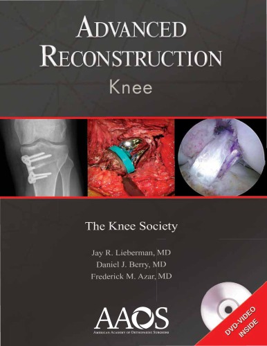 Advanced Reconstruction Knee 1st Jay R Lieberman Daniel J Berry
