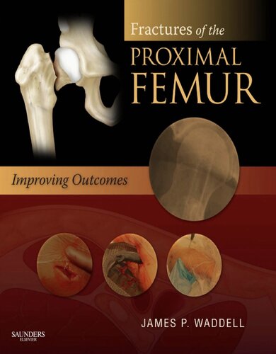 Fractures Of The Proximal Femur Improving Outcomes 1st Edition James Waddell