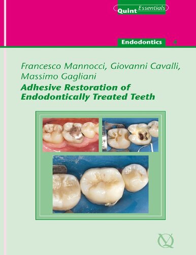 Adhesive Restoration Of Endodontically Treated Teeth Francesco Mannocci Massimo Gagliani Giovanni Cavalli