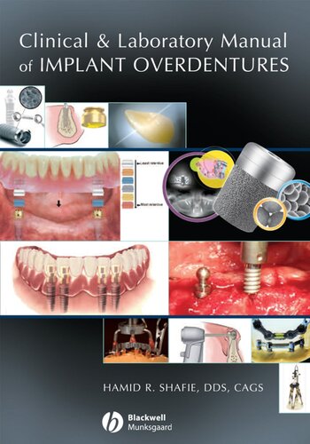 Clinical And Laboratory Manual Of Implant Overdentures 1st Edition Hamid Shafie