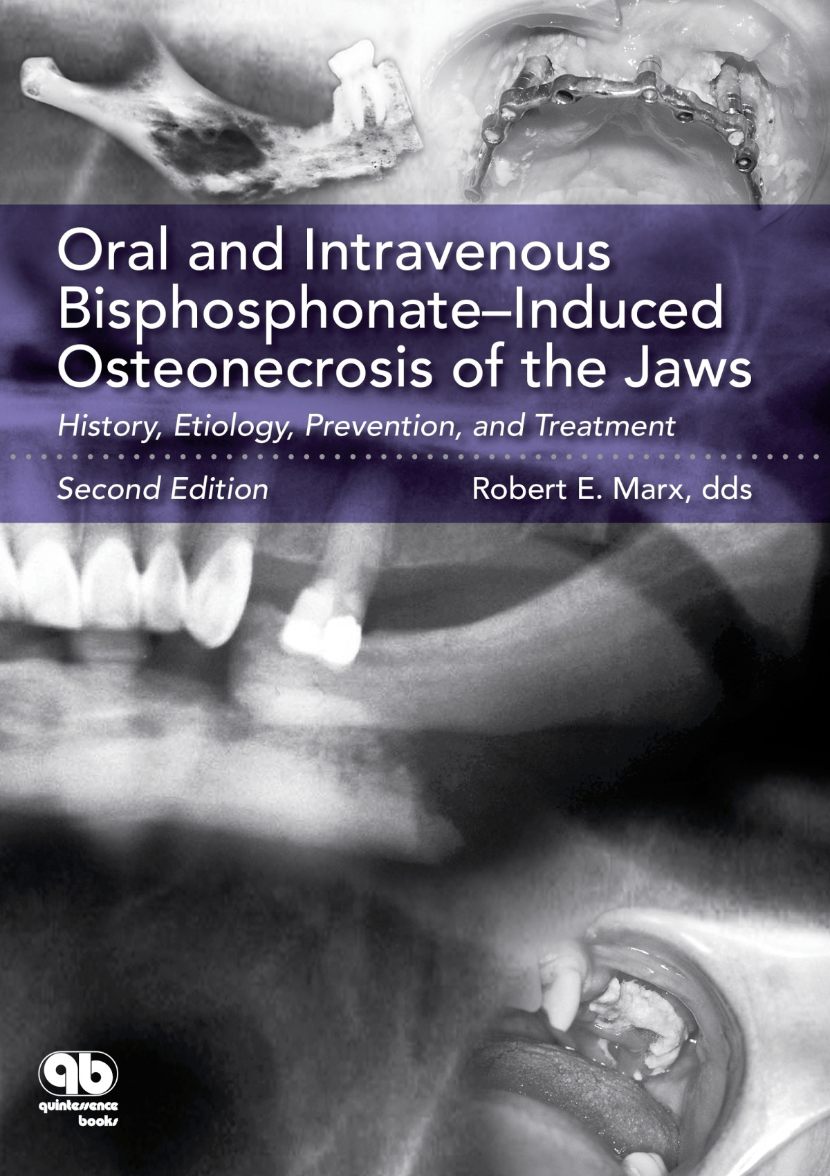 Oral And Intravenous Bisphosphonateinduced Osteonecrosis Of The Jaws Robert E Marx