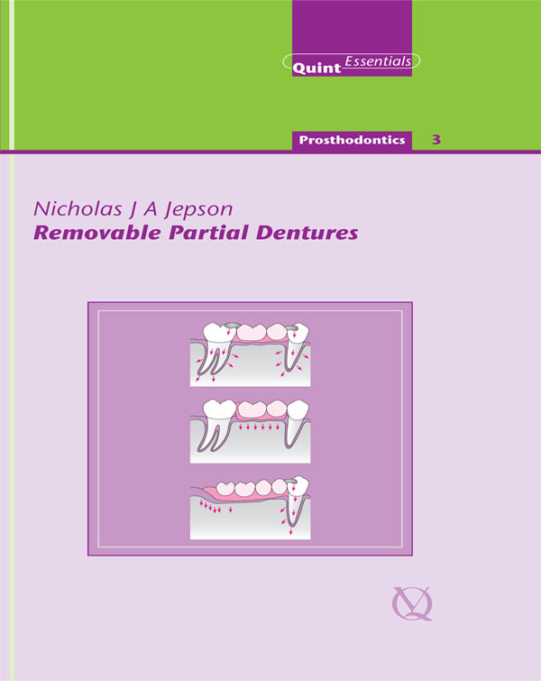 Removable Partial Dentures Nicholas J A Jepson