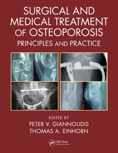 Surgical And Medical Treatment Of Osteoporosis Principles And Practice 1st Peter V Giannoudis