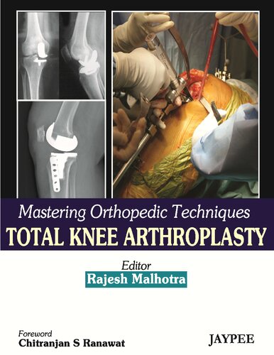 Total Knee Arthroplasty Rajesh Malhotra