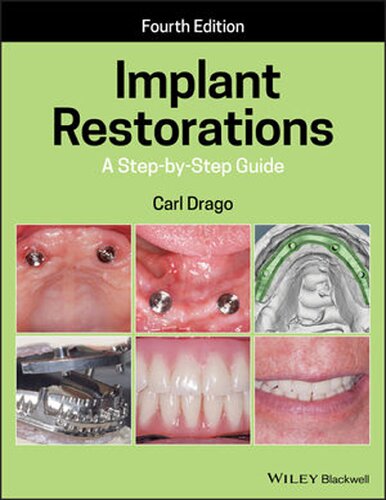 Implant Restorations A Stepbystep Guide 4th Edition Carl Drago