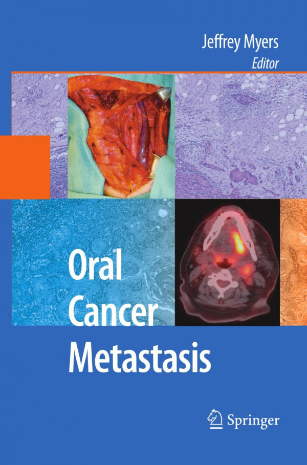 Oral Cancer Metastasis 1st Edition Eugene N Myers Auth Jeffrey Myers Eds