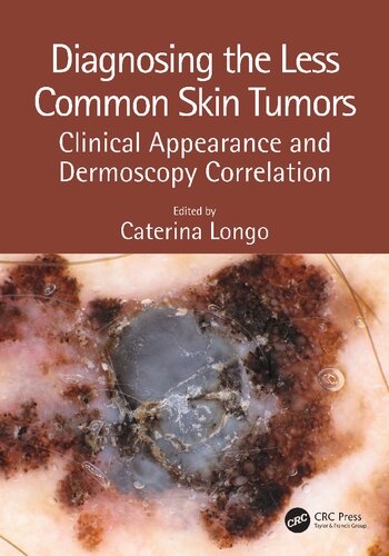 Diagnosing The Less Common Skin Tumors Clinical Appearance And Dermoscopy Correlation 1st Edition Caterina Longo