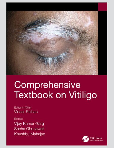 Comprehensive Textbook On Vitiligo 1st Edition Vineet Relhan