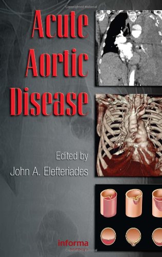 Acute Aortic Disease 1st Edition Elefteriades John