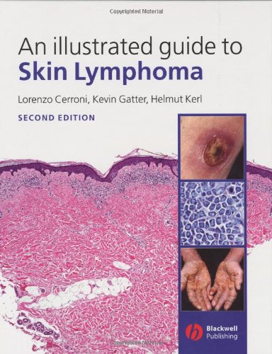 An Illustrated Guide To Skin Lymphoma 2nd Edition Lorenzo Cerroni