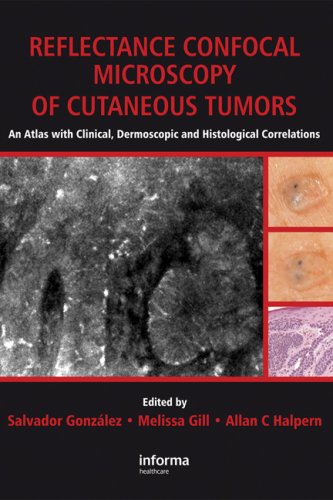 Reflectance Confocal Microscopy Of Cutaneous Tumors An Atlas With Clinical Dermoscopic And Histological Correlations 1st Edition Salvador Gonzalez