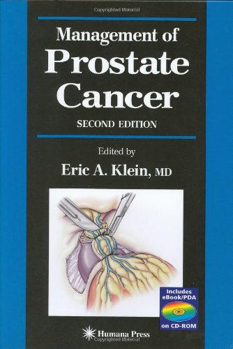 Management Of Prostate Cancer 2nd Edition Eric A Klein Eric A Klein