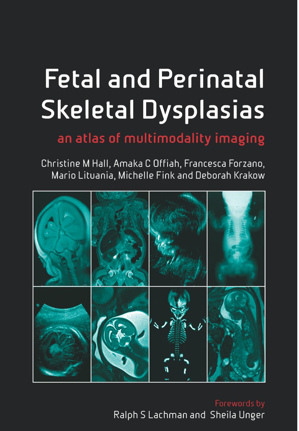 Fetal And Perinatal Skeletal Dysplasias An Atlas Of Multimodality Imaging 1st Edition Christine M Hall Author Amaka C Offiah Author Francesca Forzano Author Mario Lituania Author Michelle Fink Author Deborah Krakow Author
