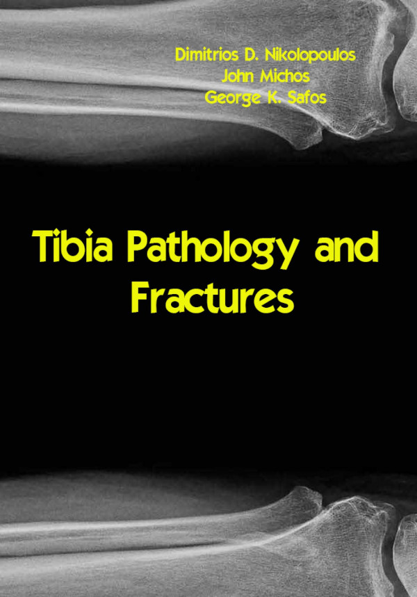 Tibia Pathology And Fractures Dimitrios D Nikolopoulos John Michos