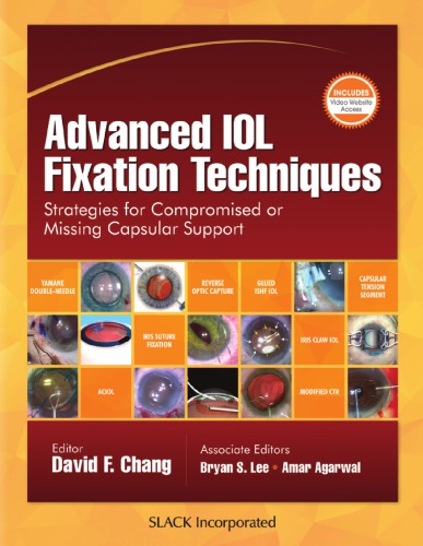 Advanced Iol Fixation Techniques Strategies For Compromised Or Missing Capsular Support 1st David F Chang