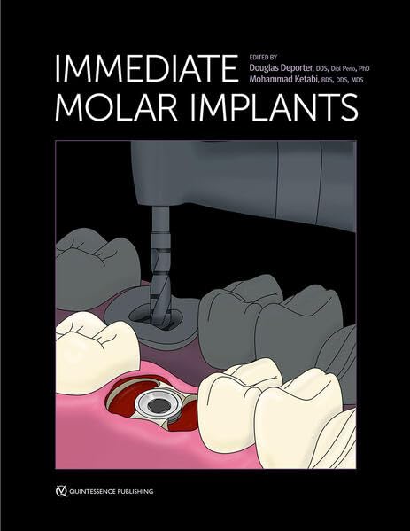 Immediate Molar Implants Douglas Deporter Mahammad Ketabi