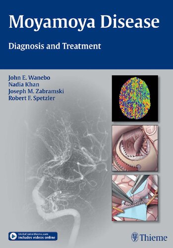 Moyamoya Disease Diagnosis And Treatment Illustrated John E Wanebo Editor