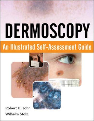 Dermoscopy An Illustrated Selfassessment Guide 1st Edition Robert Johr