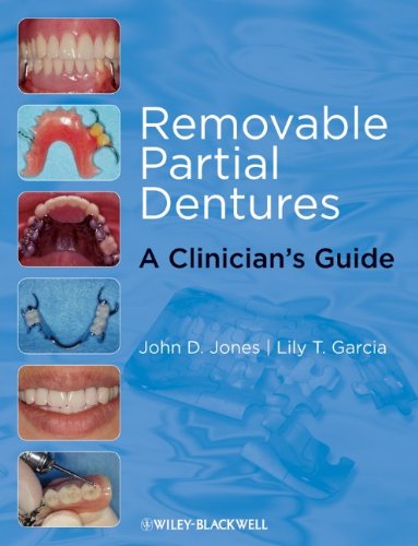 Removable Partial Dentures A Clinicians Guide Restorative Dentistry 1st Edition John D Jones