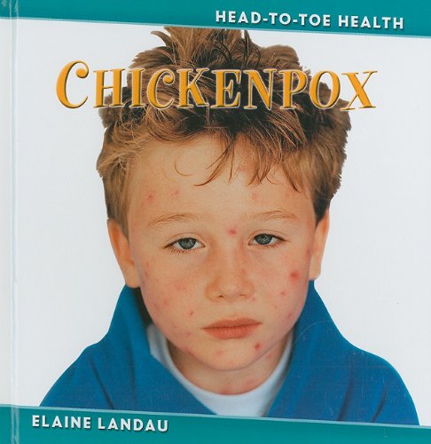 Chickenpox Headtotoe Health Elaine Landau